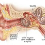 Infection l'oreille